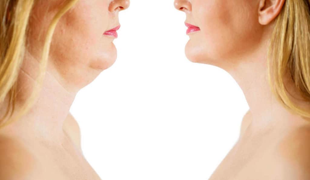 Double Chin treatment Windlesham before and after results