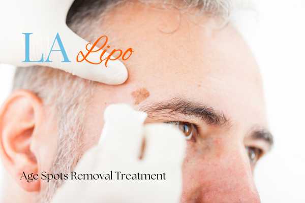 What Are the Most Effective Treatments for Age Spots Windlesham?