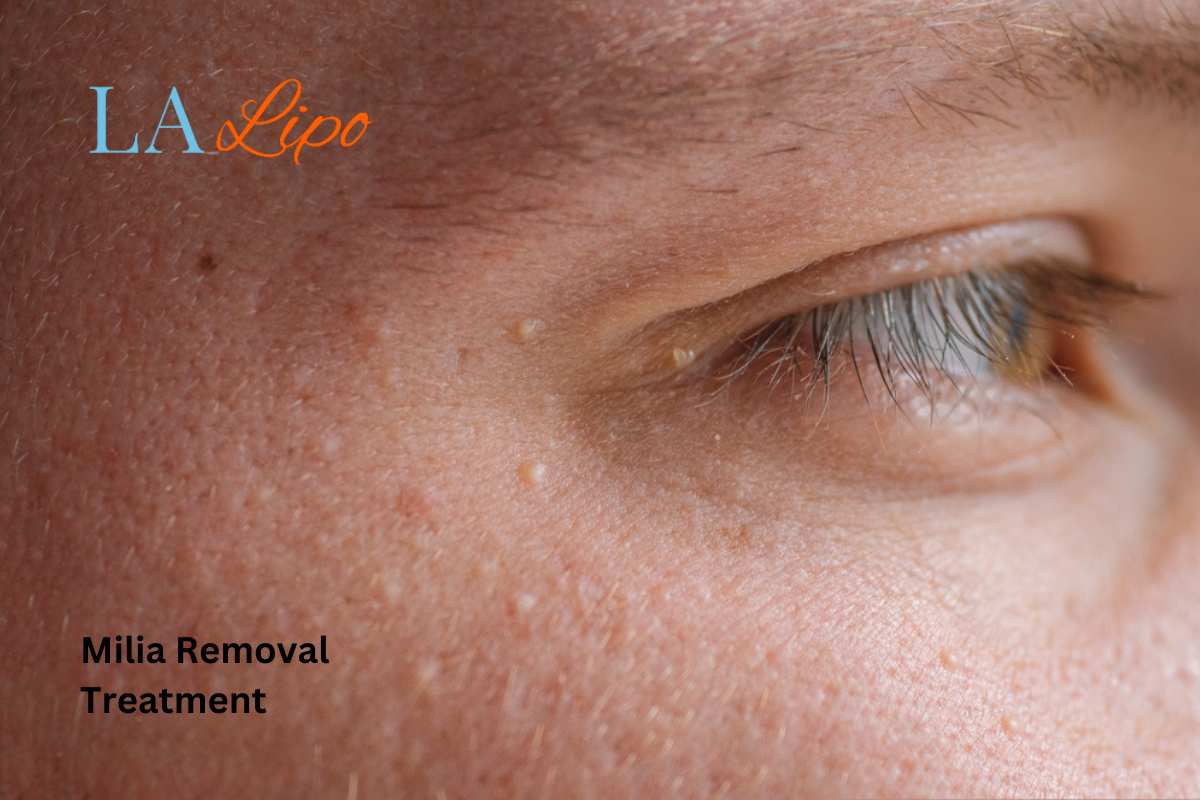 Cryopen Milia Removal: Is It the Easiest and Safest Option Windlesham?