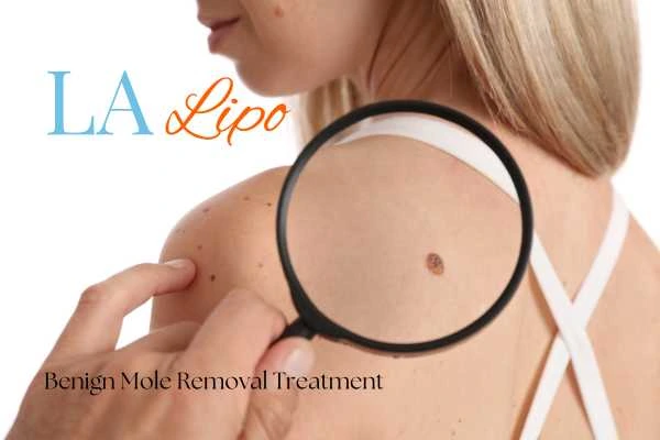 Why getting moles removed Windlesham can boost your confidence!