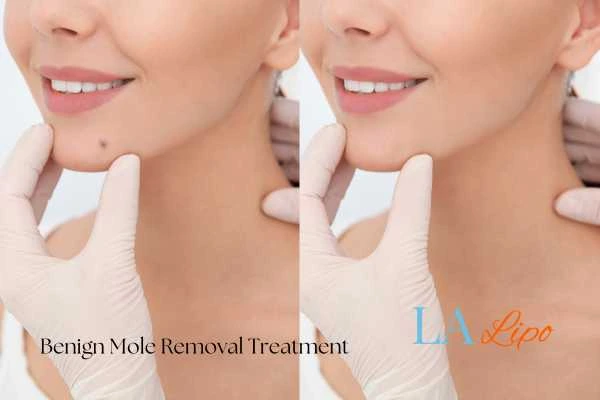 woman's before and after mole removal Windlesham results