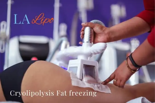 women getting fat freezing Windlesham