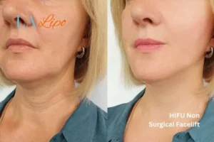 hi-fu for wrinkles Windlesham before and after results