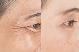 Before and after results of woman - HI-fu wrinkles reduction treatment Windlesham