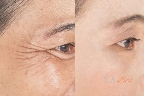 Before and after results of woman - HI-fu wrinkles reduction treatment Windlesham