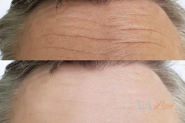 results of HIFU Windlesham on mans forehead to help reduce lines and wrinkles