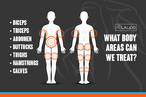 Graphic to show areas you can have LA-EMS Body Sculpting Windlesham treatment.