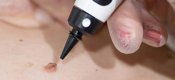 skin tag removal using cryopen Windlesham
