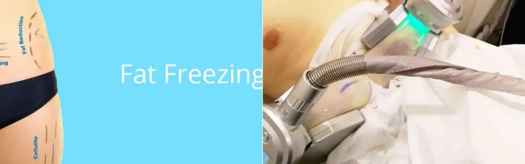 multi areas of a persons body having coolsculpting Windlesham treatment