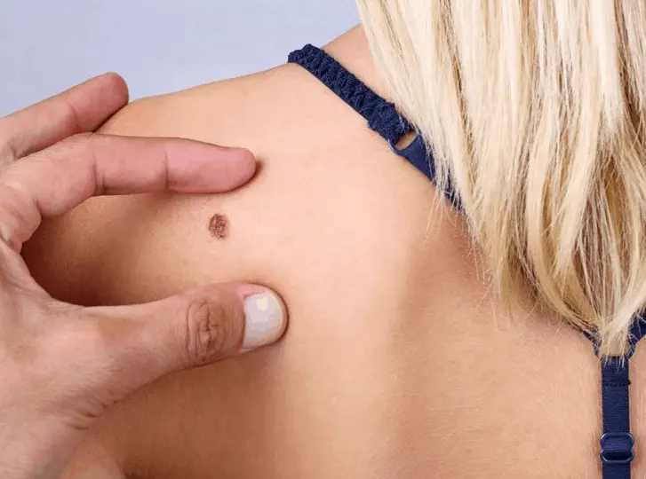 woman having mole removal Windlesham consultation before treatment.