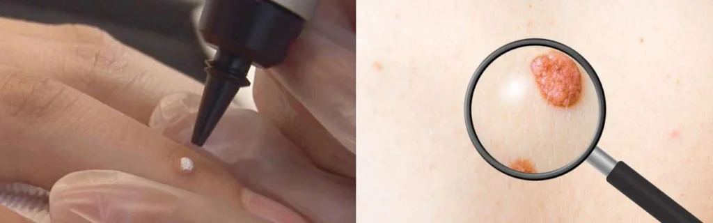 Person getting moles removed with cryopen Windlesham