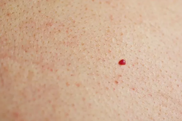 close up of a cherry angioma Windlesham