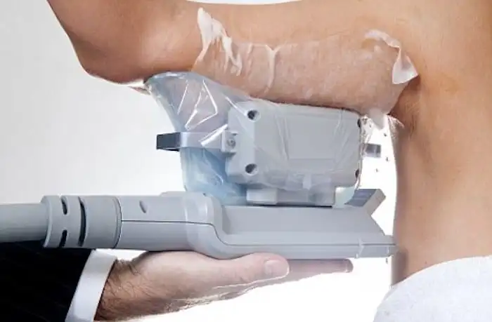 Picture of fat freezing Windlesham on the upper arms.