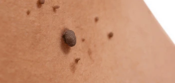 image of a skin tag Windlesham