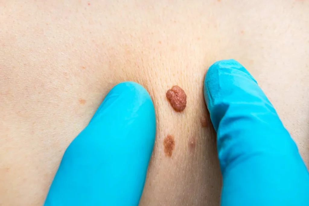 Consultant examining a skin tag Windlesham