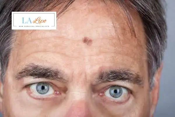 Solar Lentigo Removal Windlesham image of man with mark on his forehead