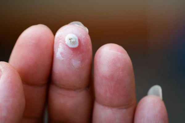 wart on person finger - cryotherapy to treat from LA LIPO Windlesham