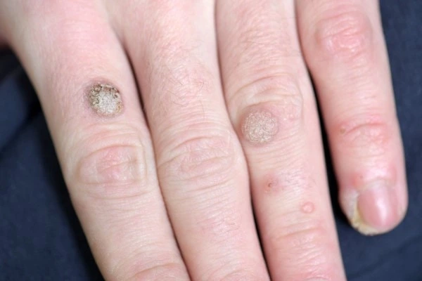photo of warts on person hand - see wart removal Windlesham from LA LIPO