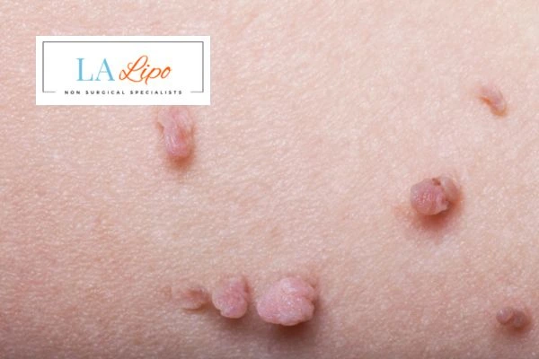 Does cryopen skin tag removal Windlesham hurt? Find out now call our team today!