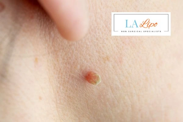Book skin tag removal Windlesham today speak to our team now!