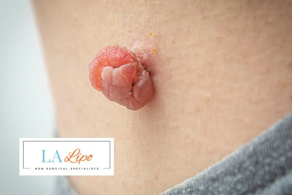 Interested in skin tag removal Windlesham? Concerned about the pain? Find out more today!