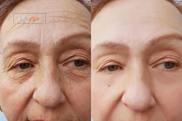 The powerful benefits of Morpheus8 Treatment Windlesham - Call Our team today!