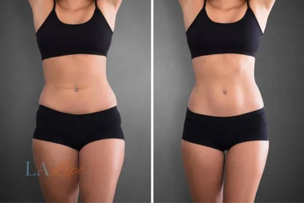 before and after results of non-surgical treatment to help a woman's body image and mental health Windlesham