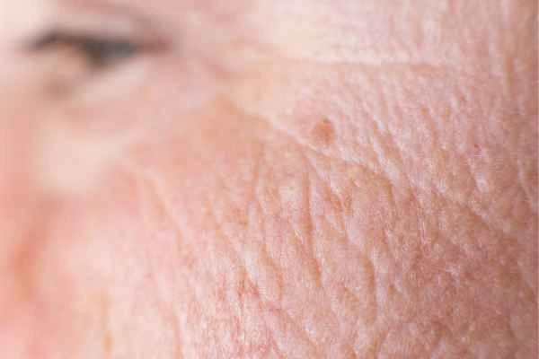 close up picture of a woman's face showing an age spot Windlesham