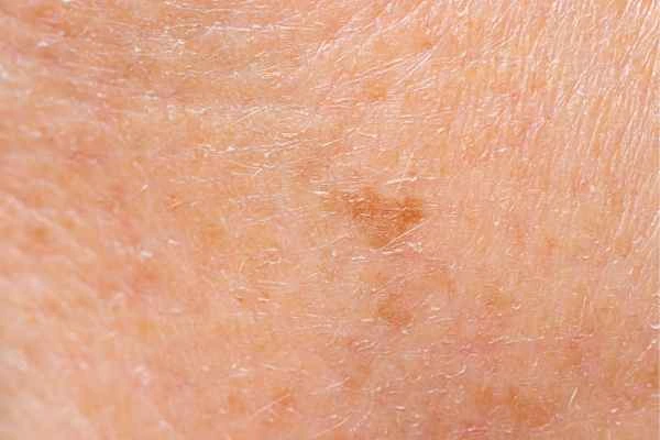 close up picture of age spots Windlesham