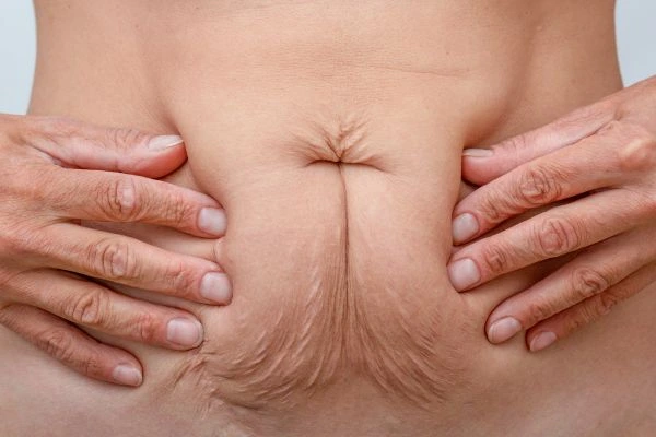 Image of a woman's stomach with loose skin - example of skin tightening Windlesham options