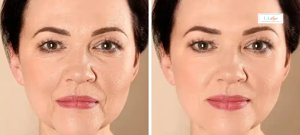 How Long Does It Take to See Results and How Long Do They Last Windlesham?