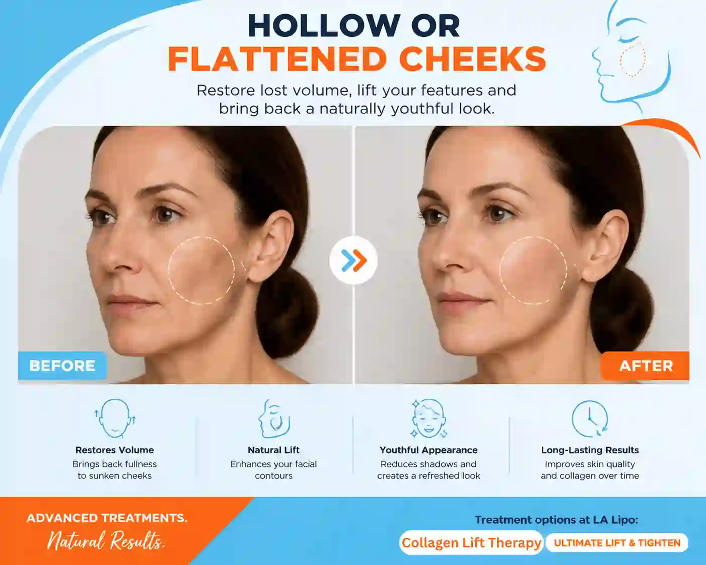 Sign #4: Hollow or Flattened Cheeks Windlesham
